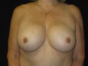 Breast Aug After