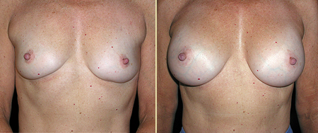 Breast Augmentation San Francisco, Breast Enlargement