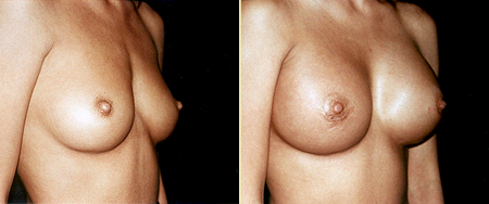 San Francisco Breast Augmentation, Breast Implants