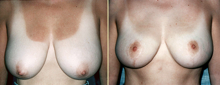 Patient 1, Front View - Breast Lift Before and After San Francisco, Ca Bay Area