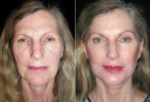 Patient 4, Front View - Facelift Before and After San Francisco, Ca Bay Area