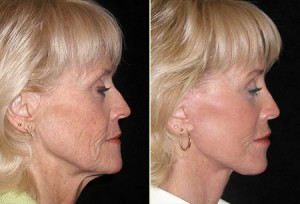 Patient 6, Side View - Facelift Before and After San Francisco, Ca Bay Area