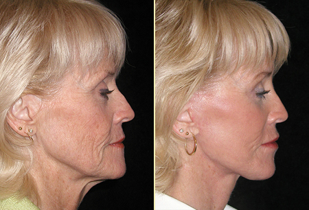 Case 3 – Face Lift Before and After in San Francisco, Ca
