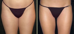 Patient 3, Front View - Liposuction Before and After San Francisco, Ca Bay Area
