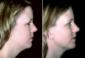 Patient 1, Side View - Neck Lift Before and After San Francisco, Ca Bay Area