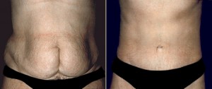 Patient 1, Front View - Tummy Tuck Before and After San Francisco, Ca Bay Area