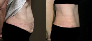 Patient 2, Side View - Tummy Tuck Before and After San Francisco, Ca Bay Area