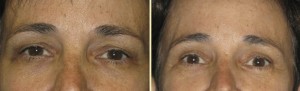 Blepharoplasty Can Correct Drooping or Sagging Eyelids