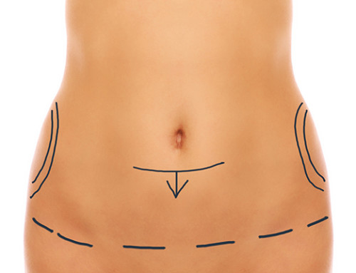 How Does a Tummy Tuck Work?