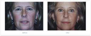 Facelift Before and After Photo