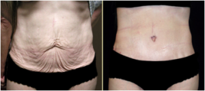 Tummy Tuck Before and After Walnut Creek