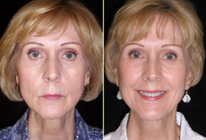 Before & After Facelift Gallery Greenbrae -walnut Creek, Ca