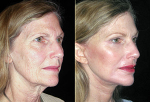 Before and After Facelift Gallery Greenbrae & Walnut Creek, Ca