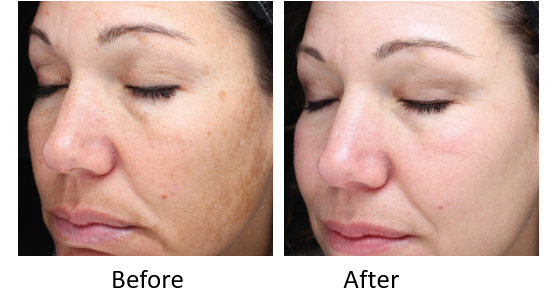 Tighten Brighten Skin Bbl Laser Treatments And Skin Tyte Walnut Creek Facial Rejuvenation Aycock Md