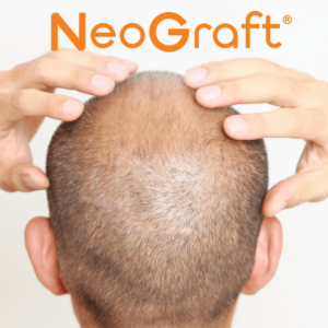 Neograft Hair Restoration Bay Area, Ca