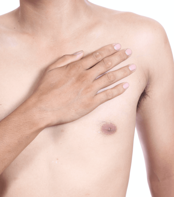 Gynecomastia Procedure in the Bay Area with Robert Aycock, Md, Facs