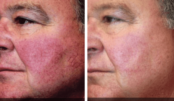 Walnut Creek Signs of Aging with a Facelift!