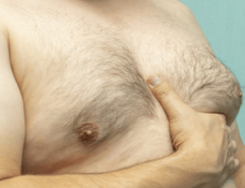 What is the Cost for Gynecomastia Surgery?