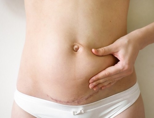 What are the Benefits of a Tummy Tuck?
